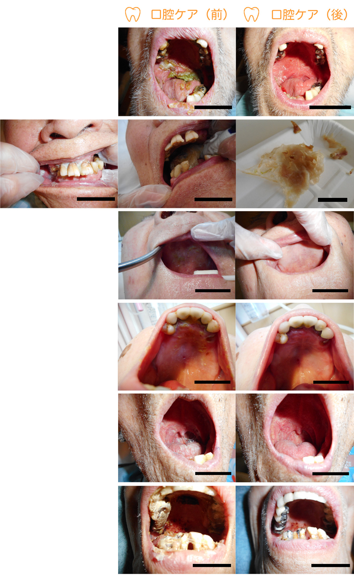 専門的口腔ケア症例